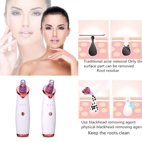 Blackhead and  Black Dot Remover Acne Vacuum Suction Tool - Image 5